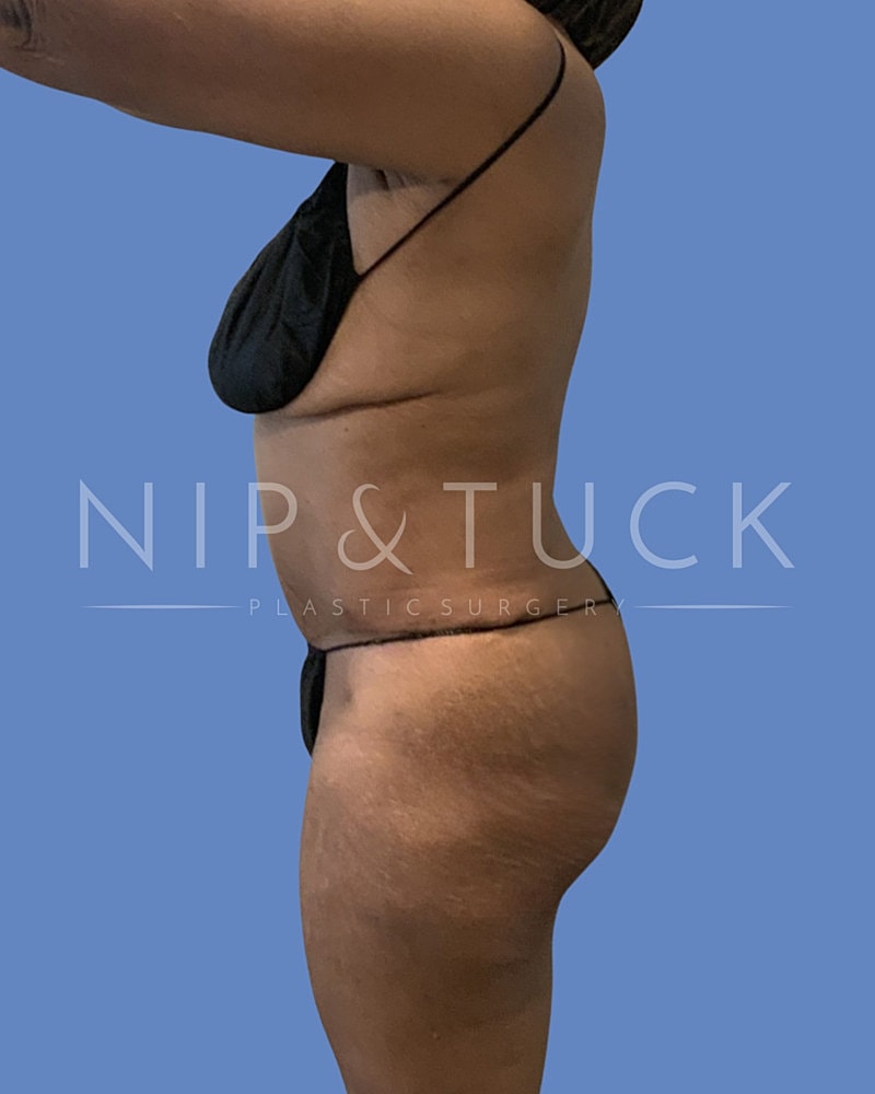 Liposuction Before & After