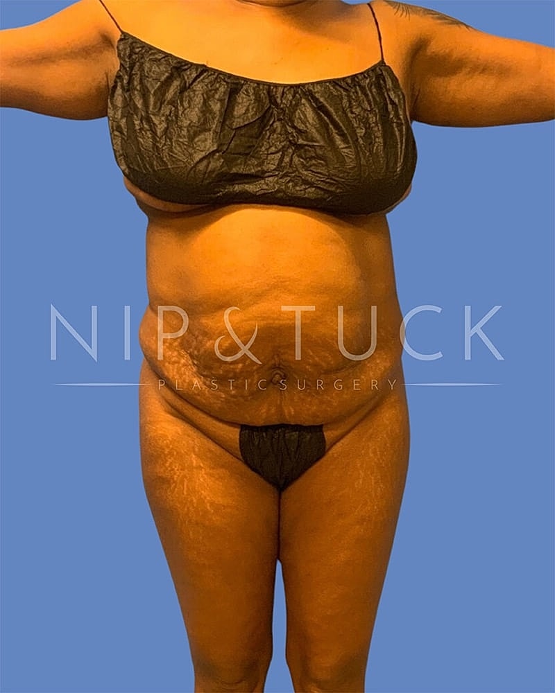 Liposuction Before & After