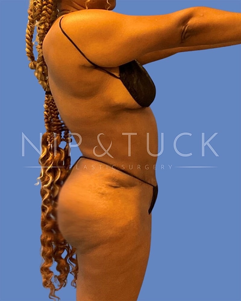 Liposuction Before & After