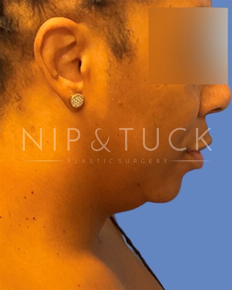 Liposuction Before & After