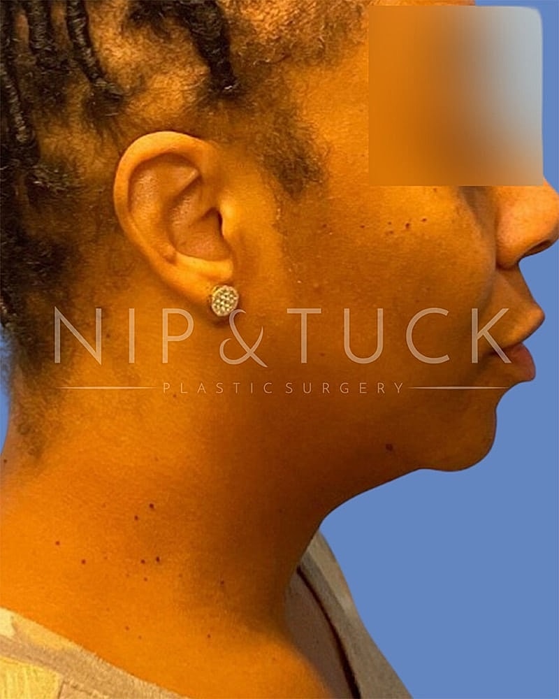 Liposuction Before & After