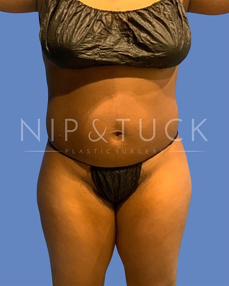 Liposuction Before & After