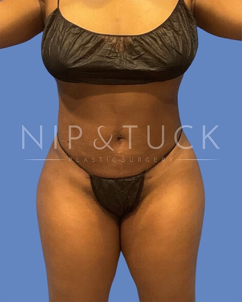 Liposuction Before & After