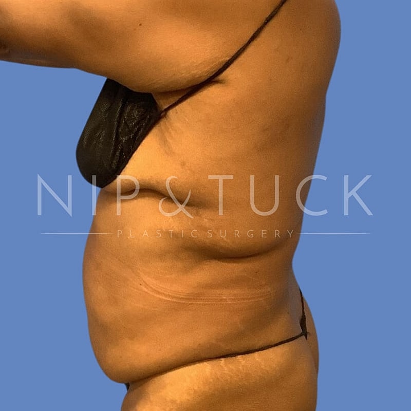 Liposuction Before & After