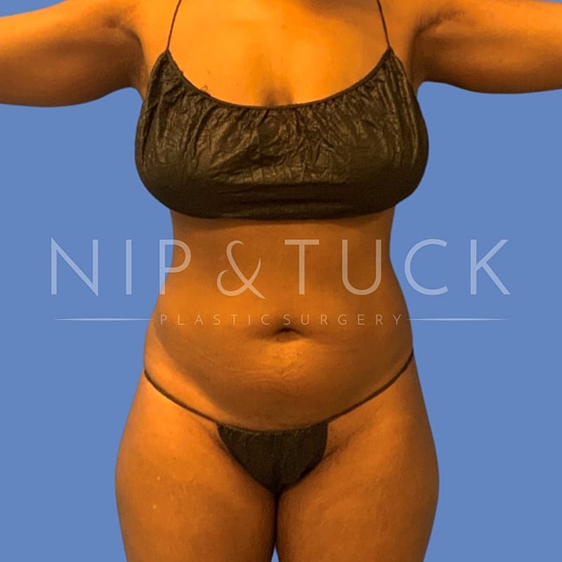 Liposuction Before & After