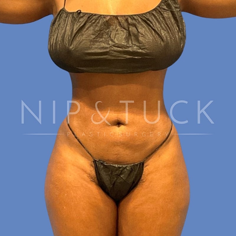Liposuction Before & After