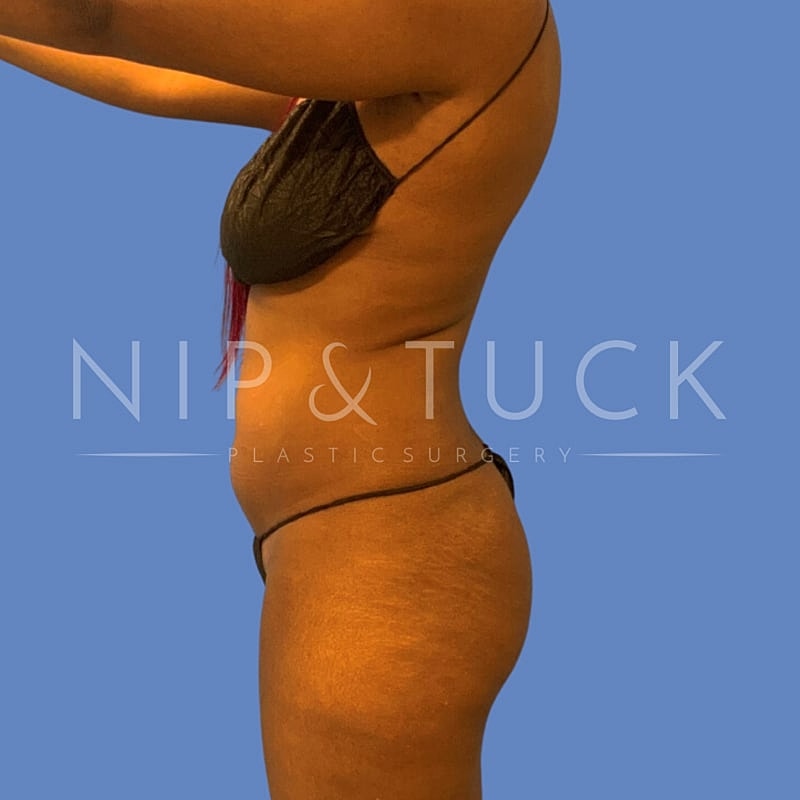 Liposuction Before & After