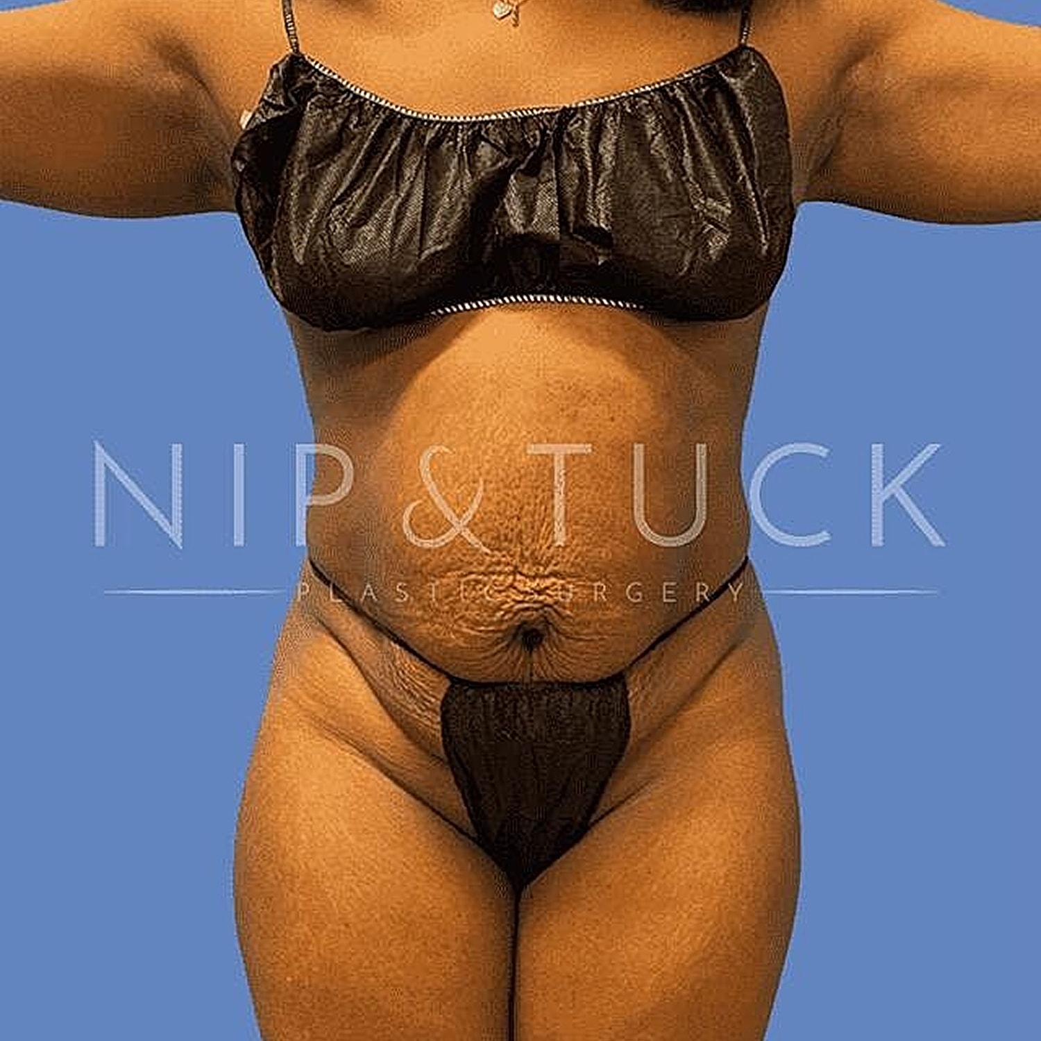 Liposuction Before & After