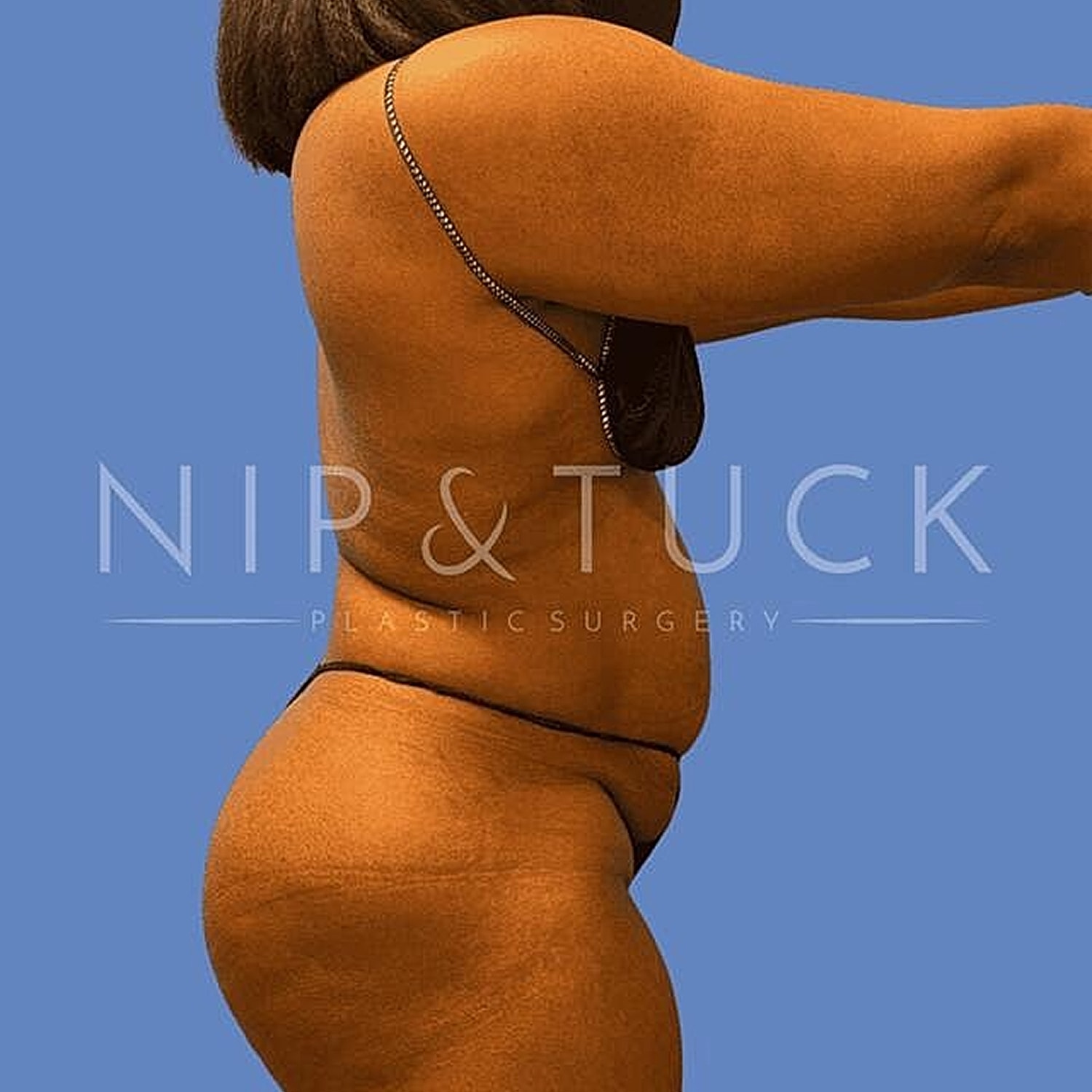 Liposuction Before & After