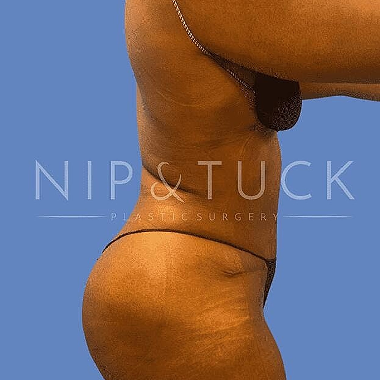 Liposuction Before & After