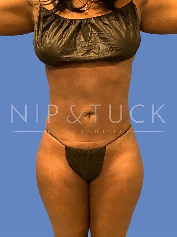 Liposuction Before & After