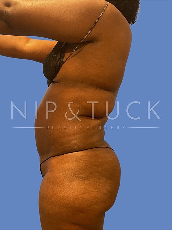 Liposuction Before & After