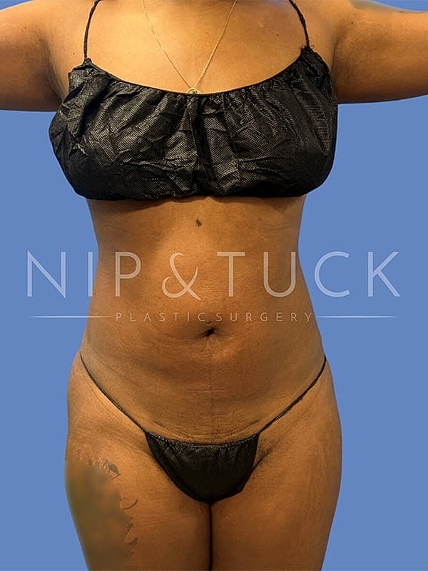 Liposuction Before & After