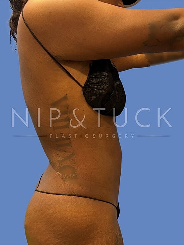 Liposuction Before & After