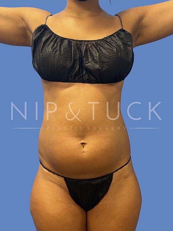 Liposuction Before & After