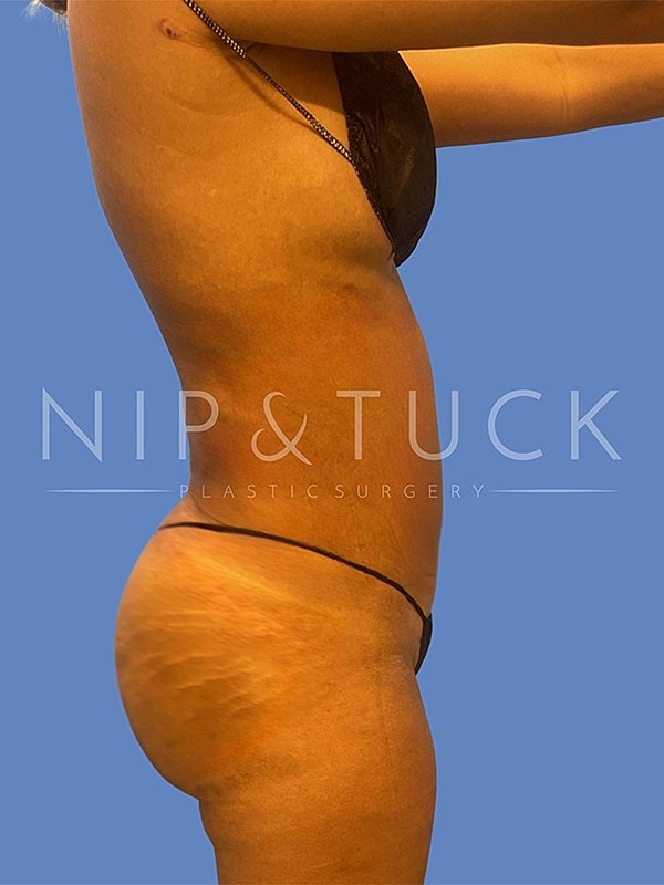 Liposuction Before & After