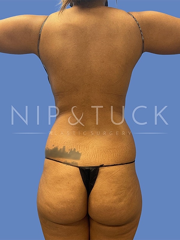 Liposuction Before & After