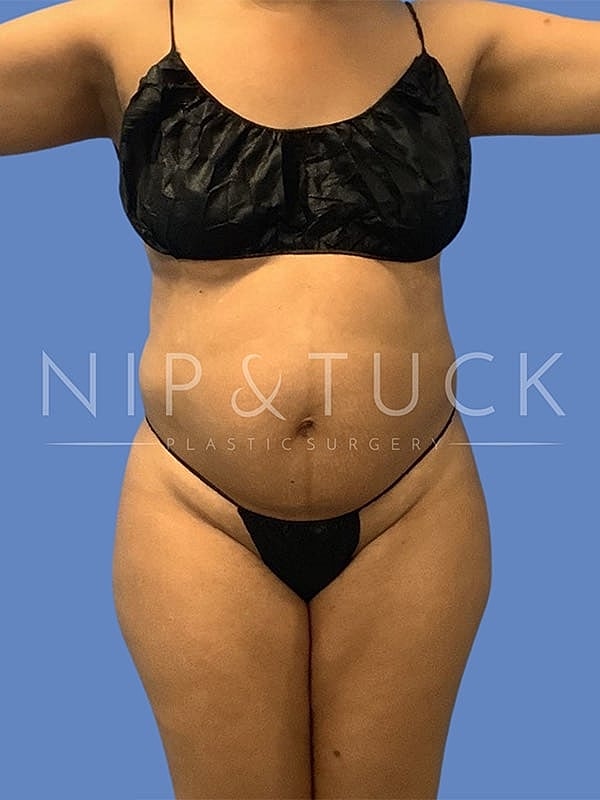 Liposuction Before & After