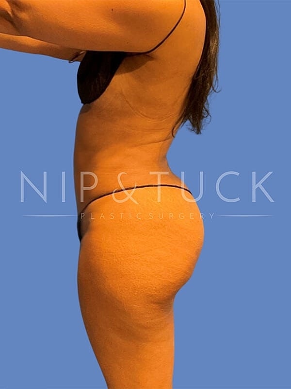 Liposuction Before & After