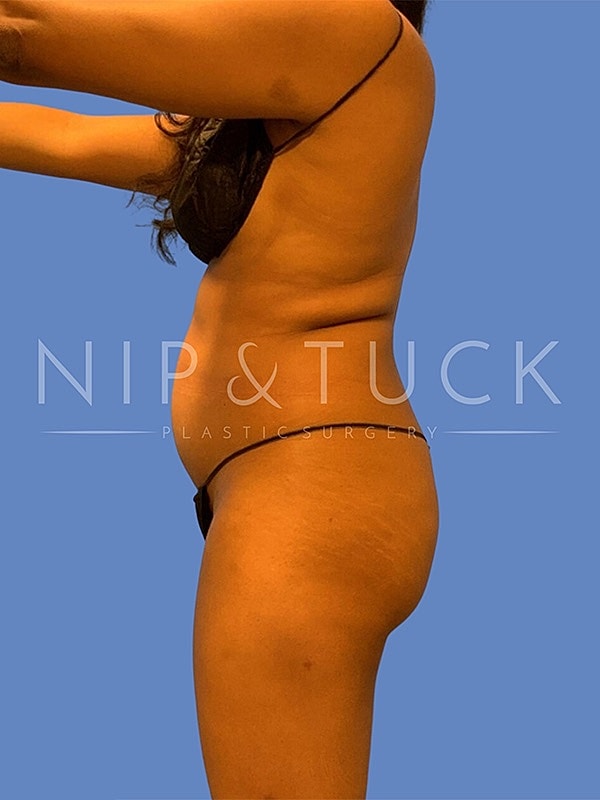 Liposuction Before & After