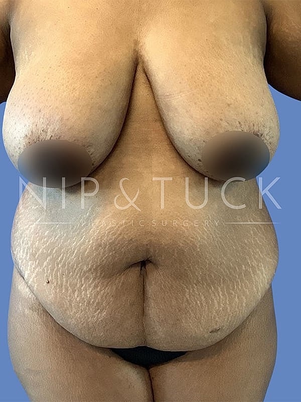 Liposuction Before & After