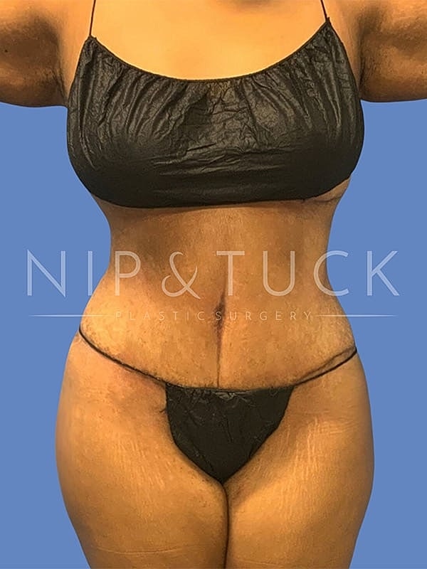 Liposuction Before & After