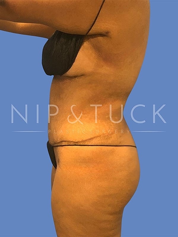 Liposuction Before & After