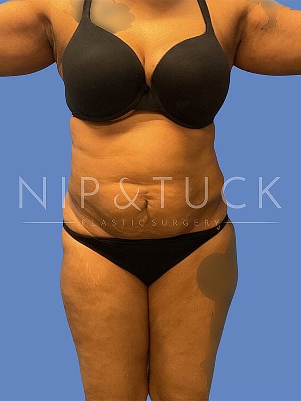 Liposuction Before & After