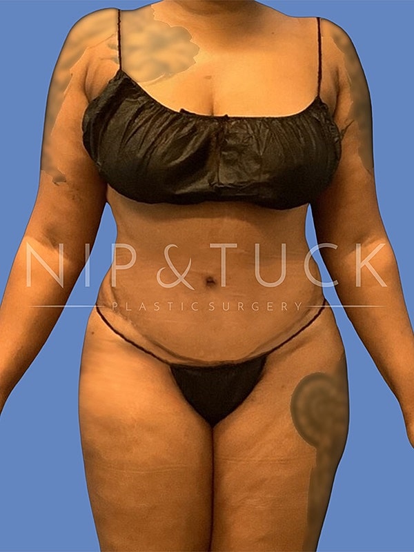 Liposuction Before & After