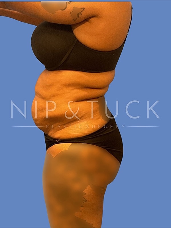 Liposuction Before & After