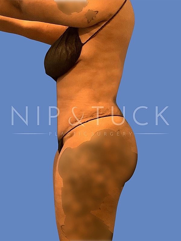 Liposuction Before & After