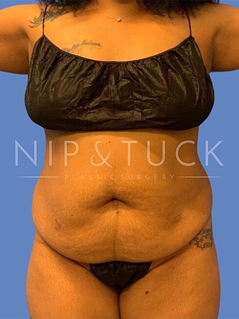 Liposuction Before & After