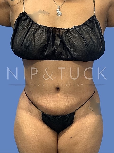 Liposuction Before & After