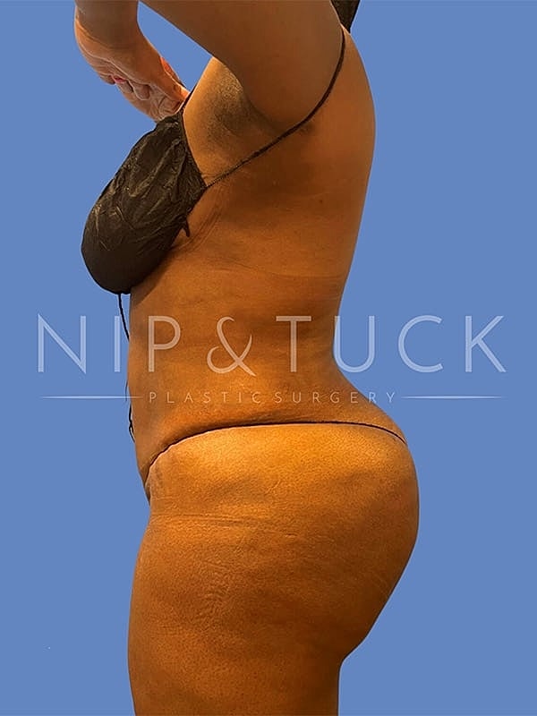 Liposuction Before & After