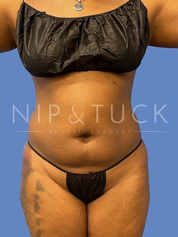 Liposuction Before & After