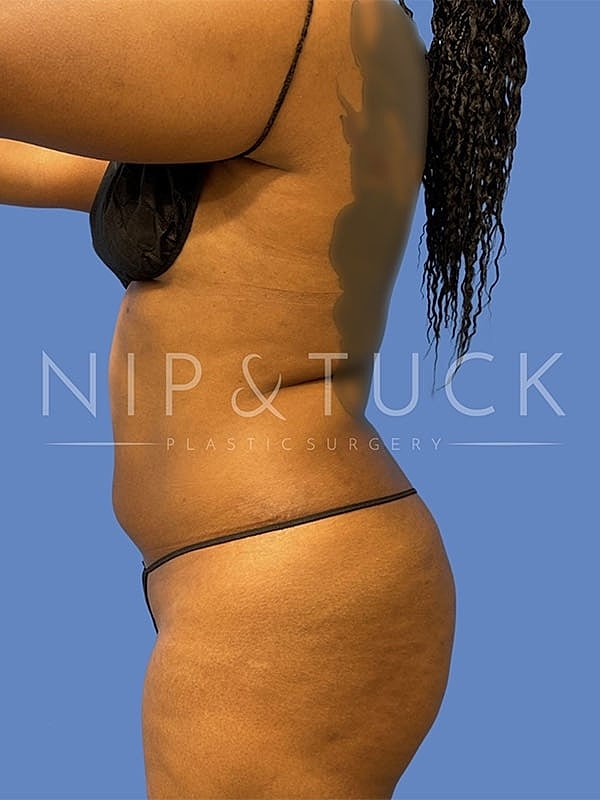 Liposuction Before & After