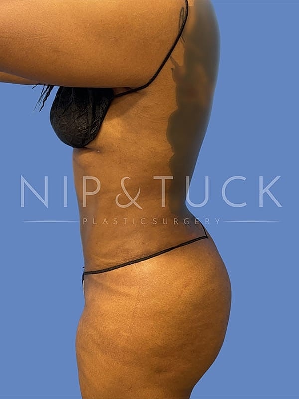 Liposuction Before & After