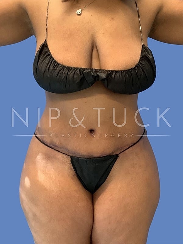 Liposuction Before & After