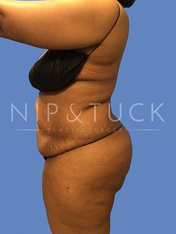 Liposuction Before & After