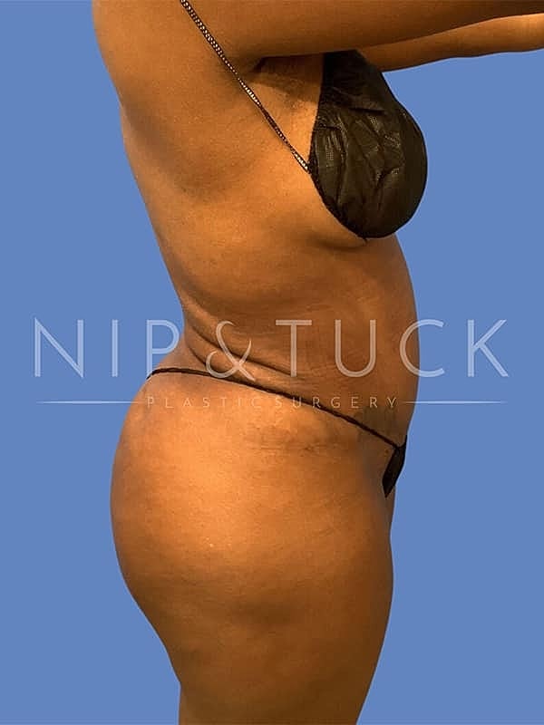 Liposuction Before & After