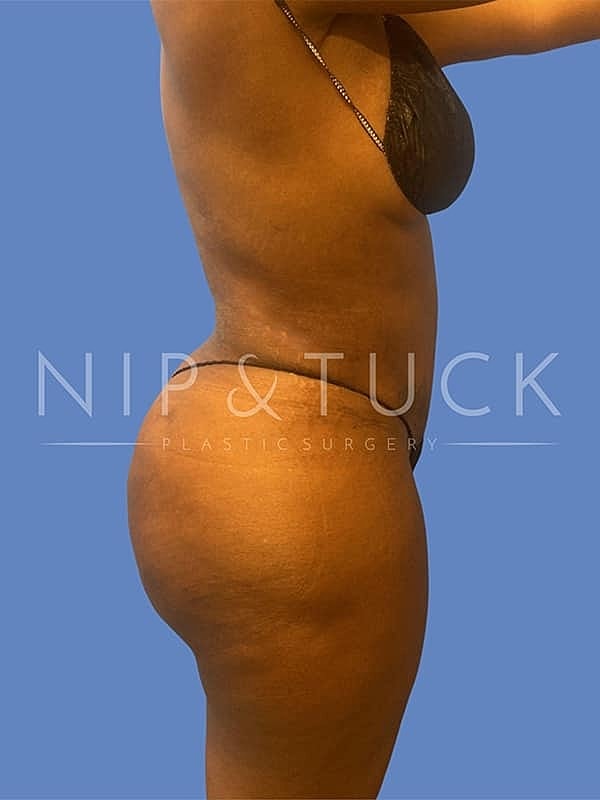 Liposuction Before & After