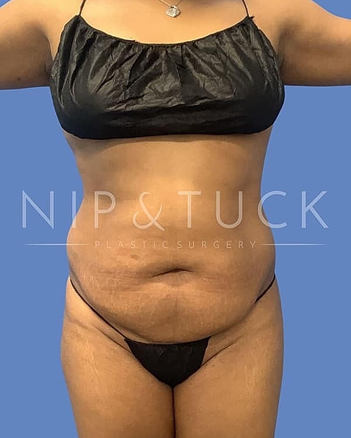 Liposuction Before & After