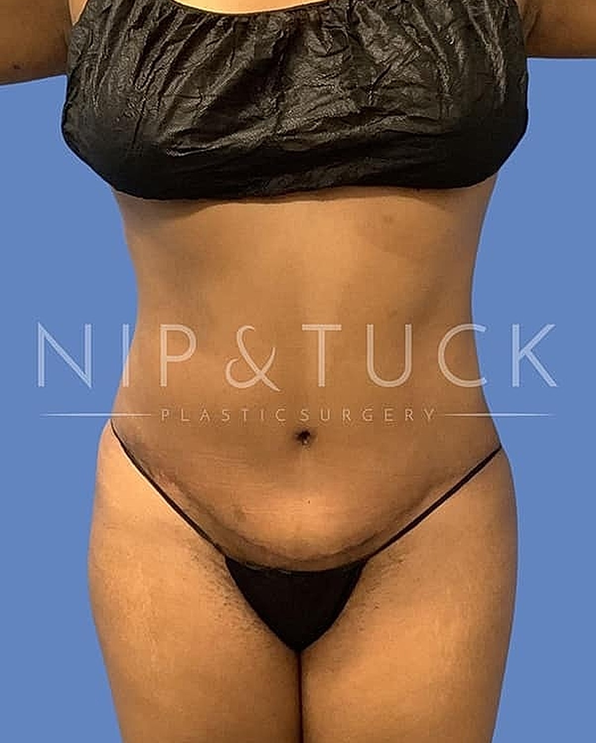 Liposuction Before & After