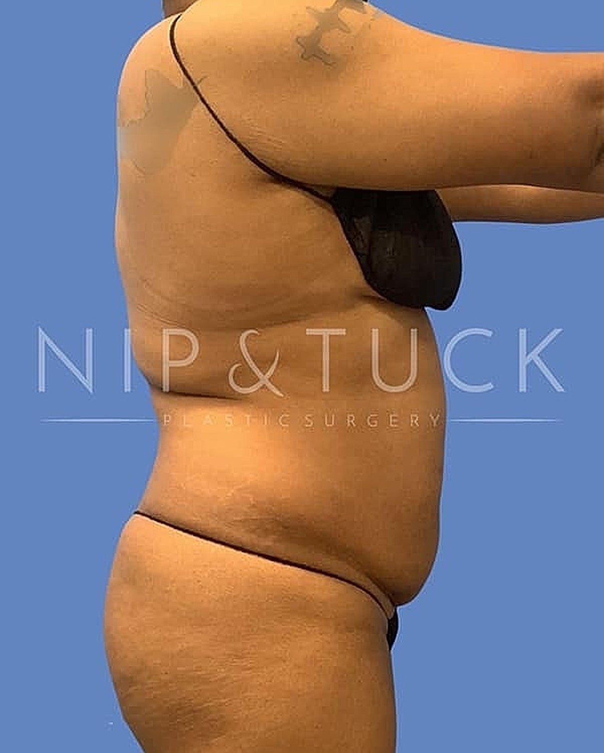 Liposuction Before & After