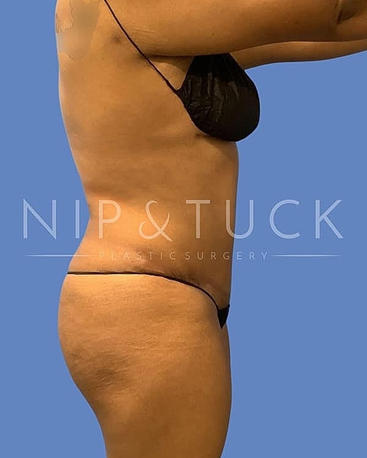 Liposuction Before & After