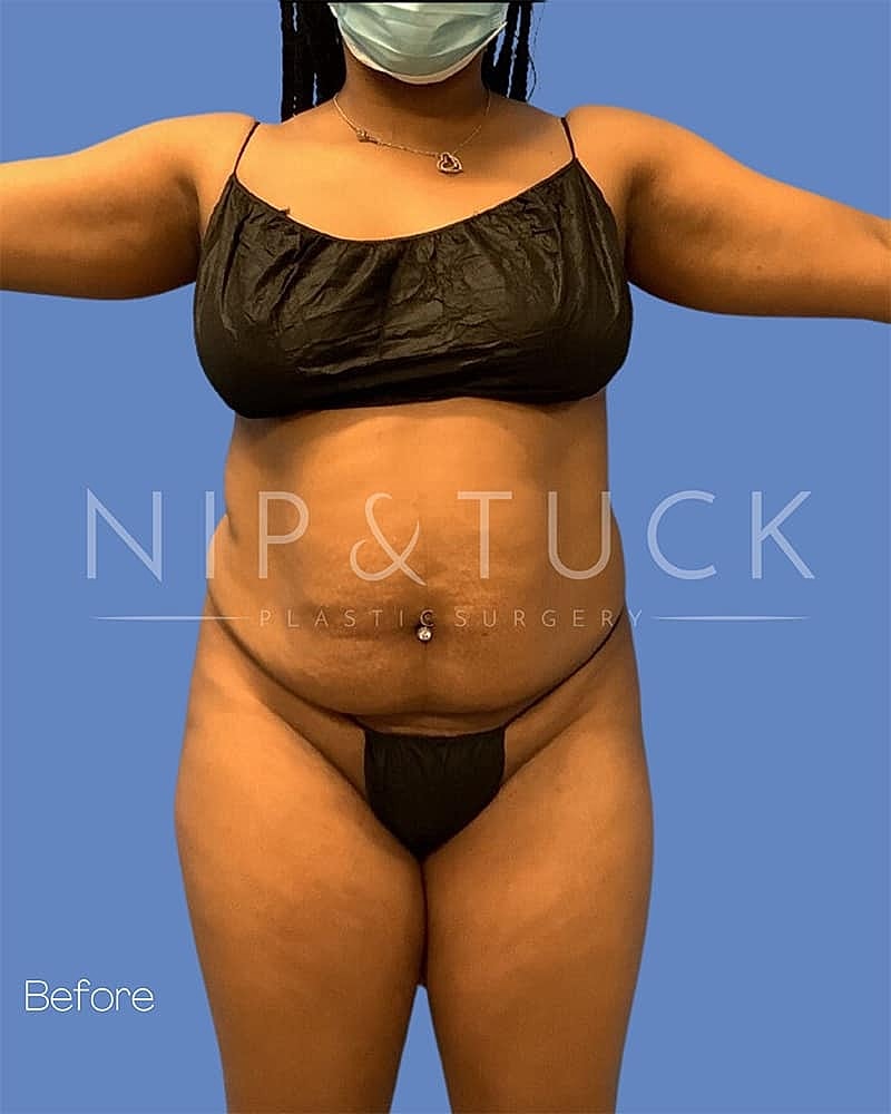 Liposuction Before & After