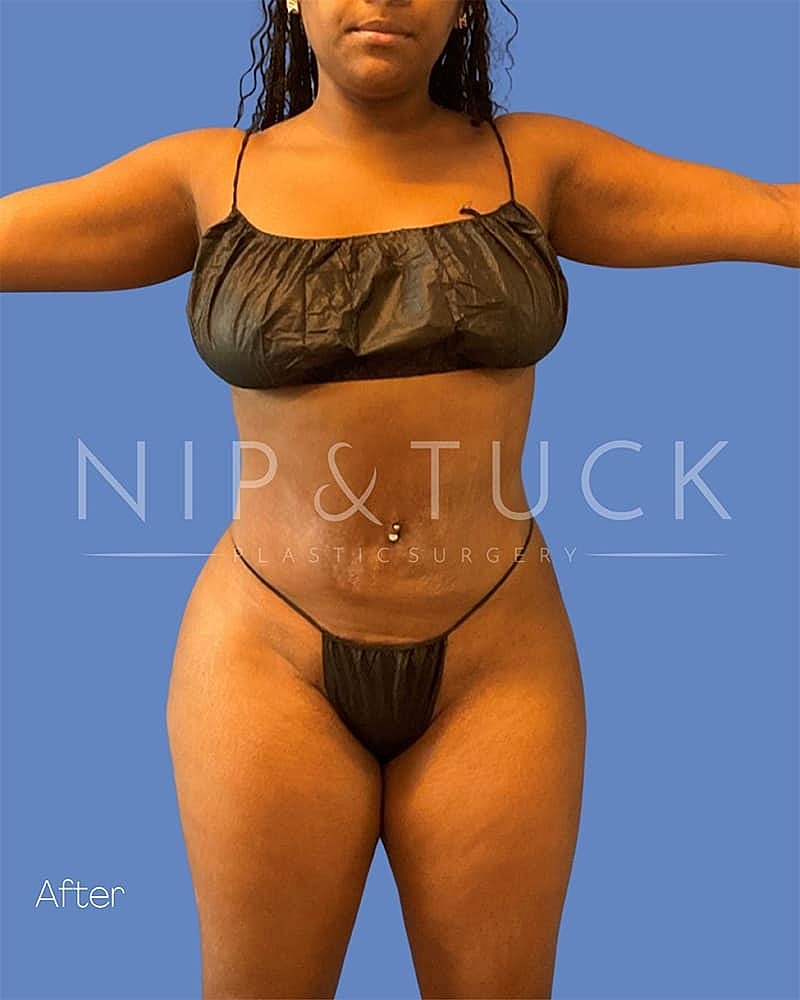 Liposuction Before & After