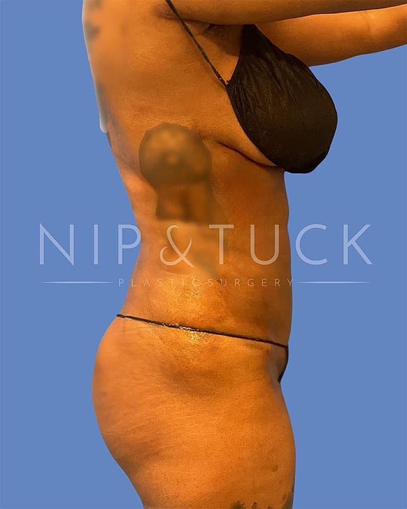 Liposuction Before & After