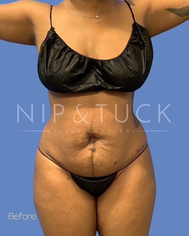 Liposuction Before & After