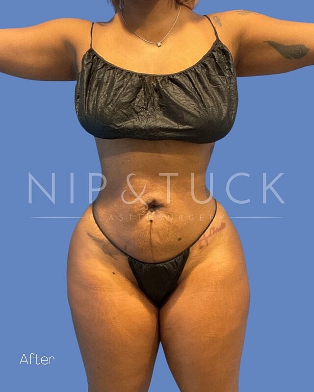Liposuction Before & After